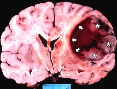 Ο καρκίνος ξεκινά από το μυαλό - Τα σημεία του σώματος που προσβάλλονται ανάλογα με τη διάθεση μας (βίντεο)